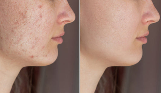 Skincare for Acne Prone Skin Tips to follow