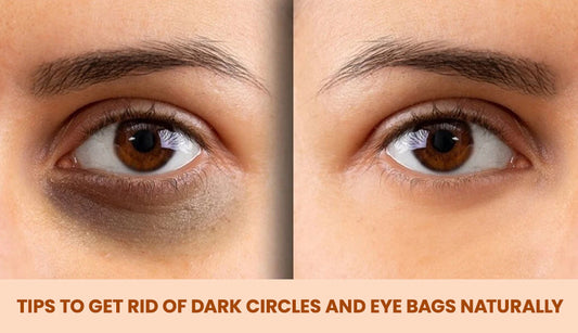 Tips To Get Rid of Dark Circles and Eye Bags Naturally