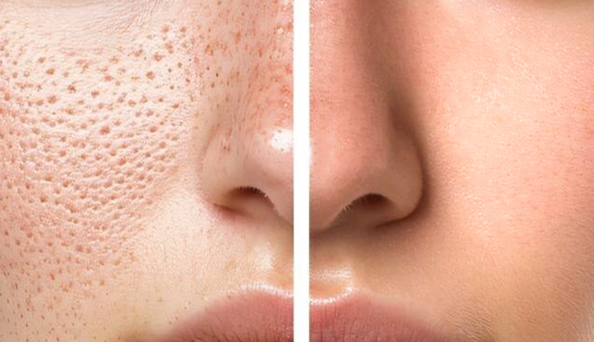 Tips to Manage Open Pores