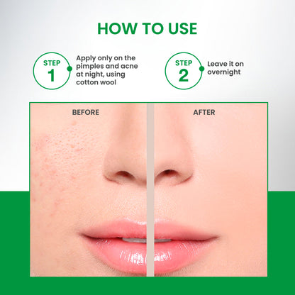 Shahnaz Husain Shaclear Plus Skin Clear Anti-Pimple Lotion | 100ml